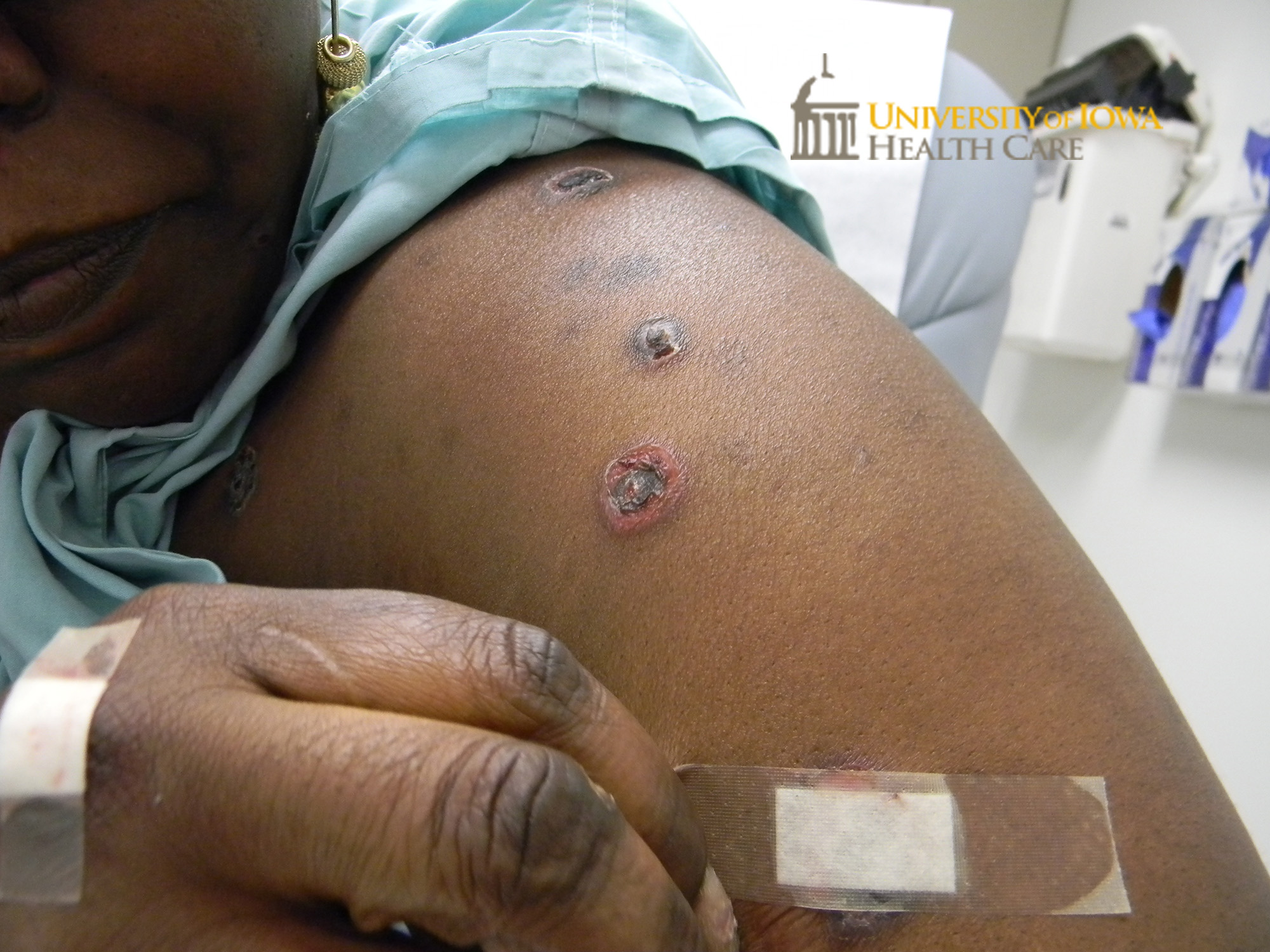 Circular erosions with hemorrhagic crust on the arms. (click images for higher resolution).